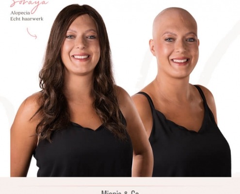 alopecia, alopecia totalis, pruik kopen, haarwerk kopen, pruik, haarwerk, haarverlies