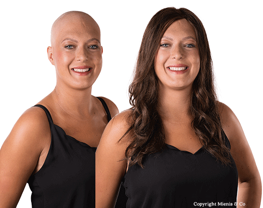 alopecia, lotgenoten, alopecia totalis